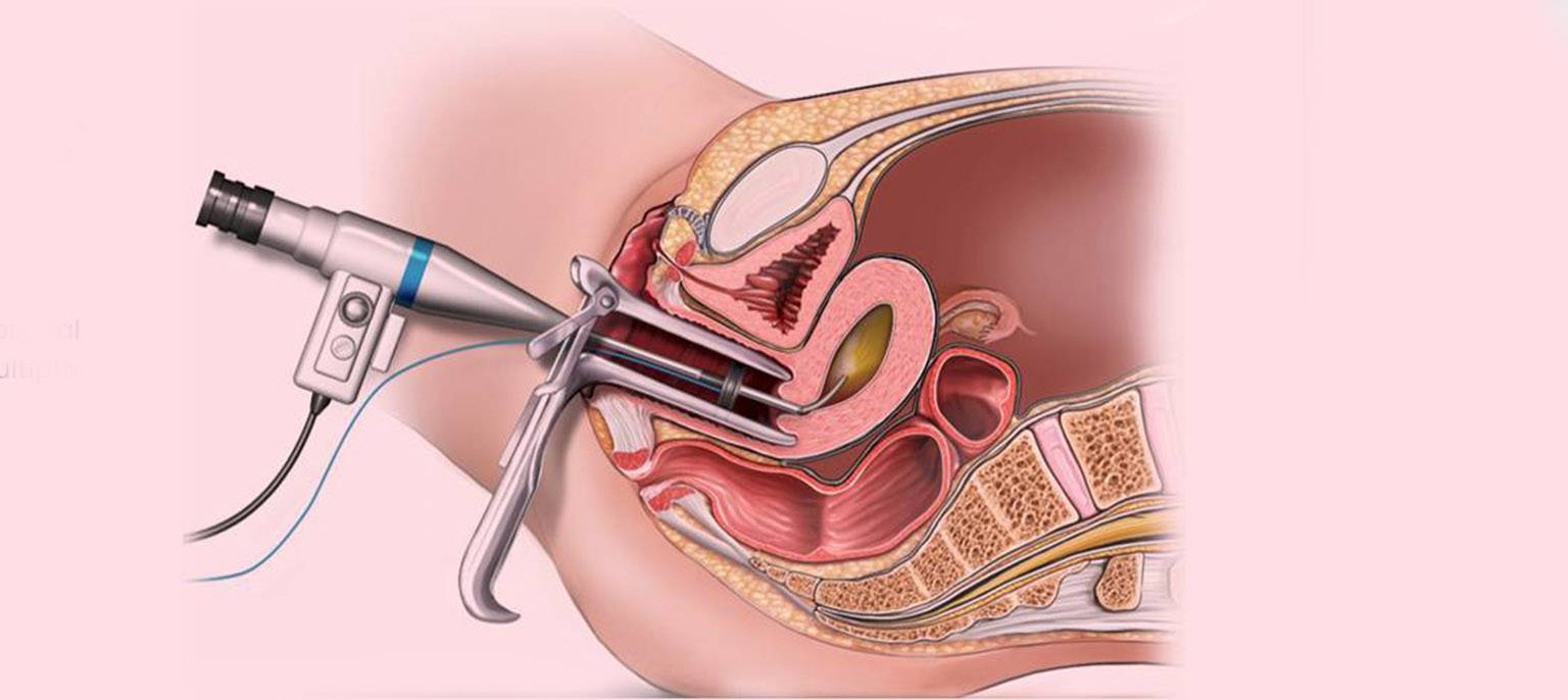 Hysteroscopy